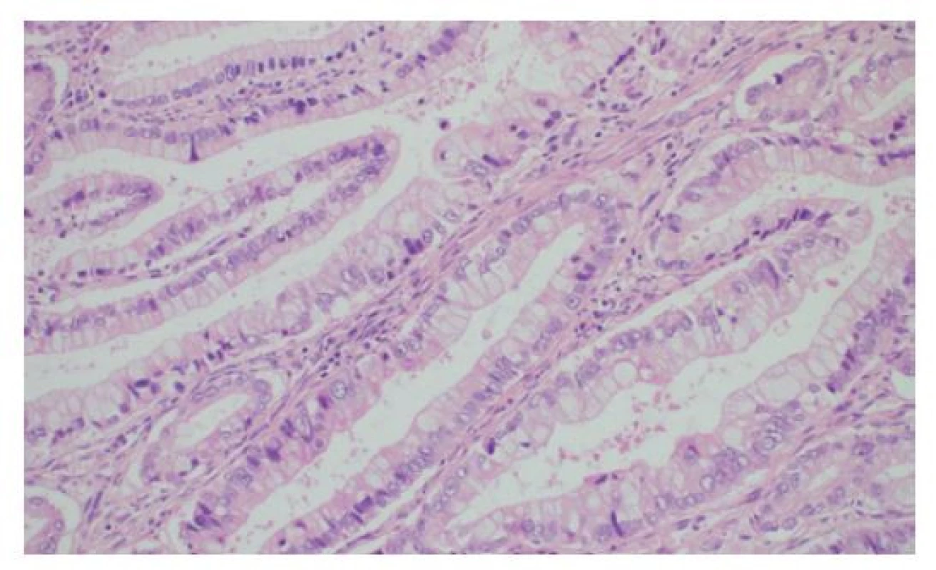 Histologie cholangiocelulárního adenokarcinomu
jater tubulární stavby s denzně nahloučenými žlázkami
s hlenotvorbou a jadernými atypiemi, HE, 200×<br>
Fig. 3: Histology of liver cholangiocellular adenocarcinoma
characterized by tubular arrangement, with closely
packed mucinous glands with nuclear atypia, HE, 200×