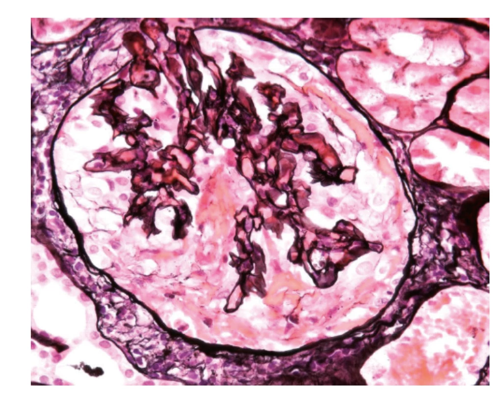 Biopsie ledviny, zachycený glomerulus je částečně
postižen sklerotizací, je vidět fibrózní srpek (1), není přítomný
polymorfonukleární infiltrát, který by znamenal aktivní postižení