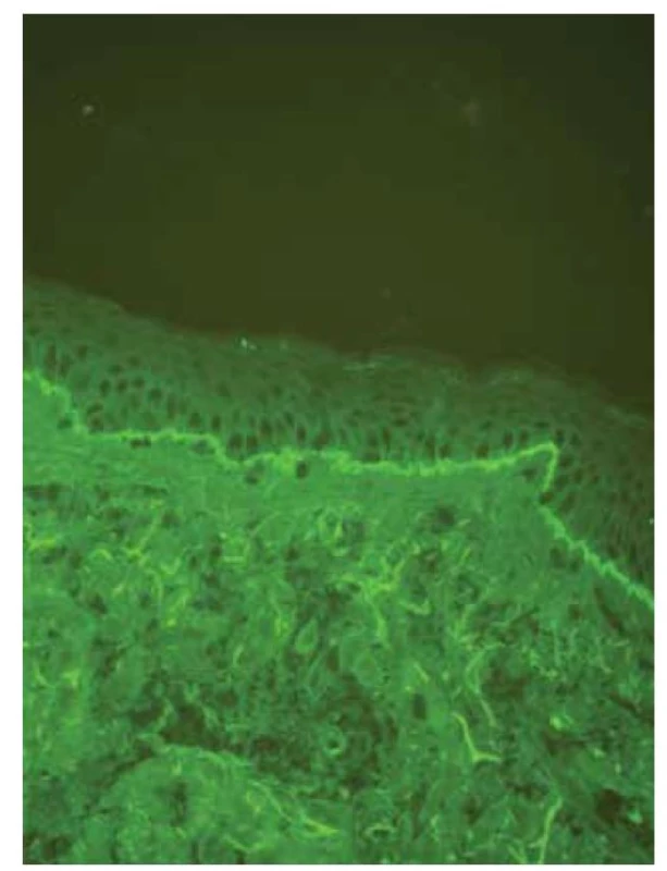 V přímé imunofluorescenci patrný lem tvořený C3
složkou komplementu pod epidermis s n-vroubkováním