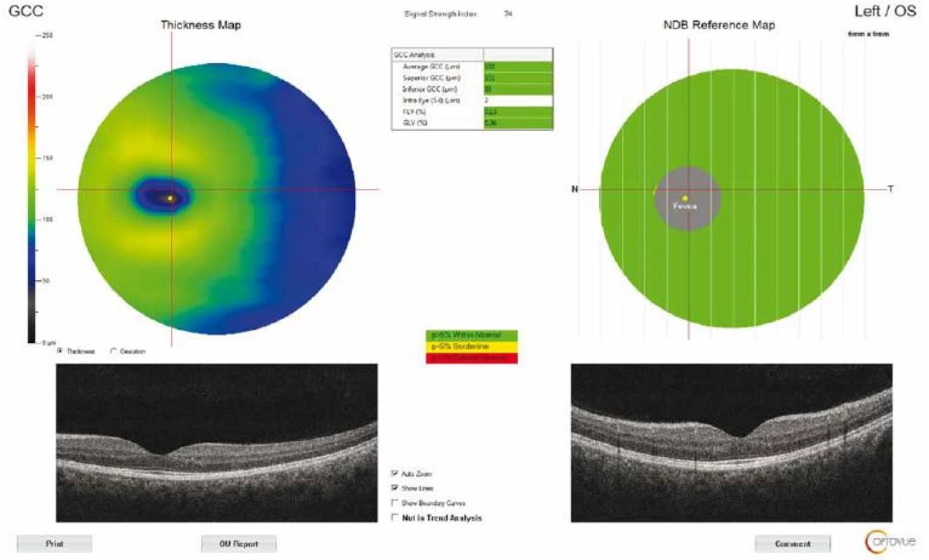 Optical coherence tomography output of ganglion cell complex thickness measurement of a patient with idiopathic intracranial
hypertension.
GCC – ganglion cell complex; NDB – normative database<br>
Obr. 3. Výsledek měření tloušťky komplexu gangliových buněk pomocí optické koherentní tomografie u pacienta s idiopatickou intrakraniální
hypertenzí.
GCC – komplex gangliových buněk; NDB – normativní databáze