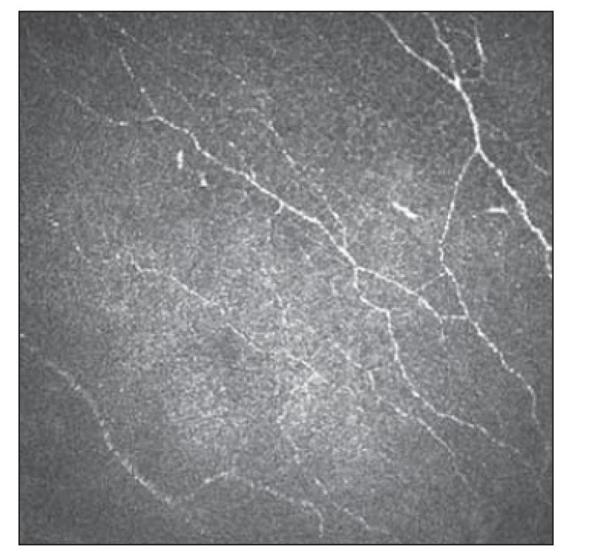 Subbazální plexus s úbytkem
vláken 2.<br>
Fig. 4. Subbasal plexus with fiber
reduction 2.