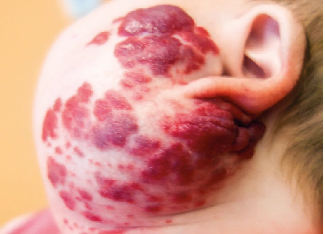Smíšený IH v oblasti parotis.<br>
Mixed parotid gland IH.