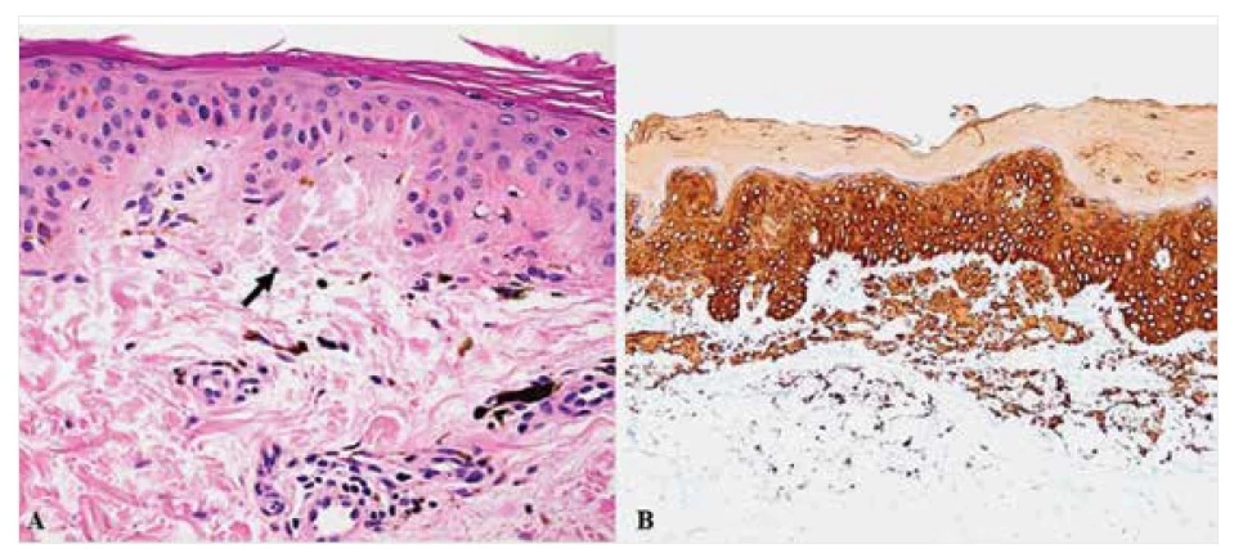 Makulózní amyloidóza – histopatologie<br>
Drobná amorfní depozita amyloidu v papilární dermis (šipka) v barvení HE (A), pozitivní v imunohistochemických
reakcích s primární protilátkou proti HMWCK (B). Původní zvětšení 400krát (A) a 100krát (B).