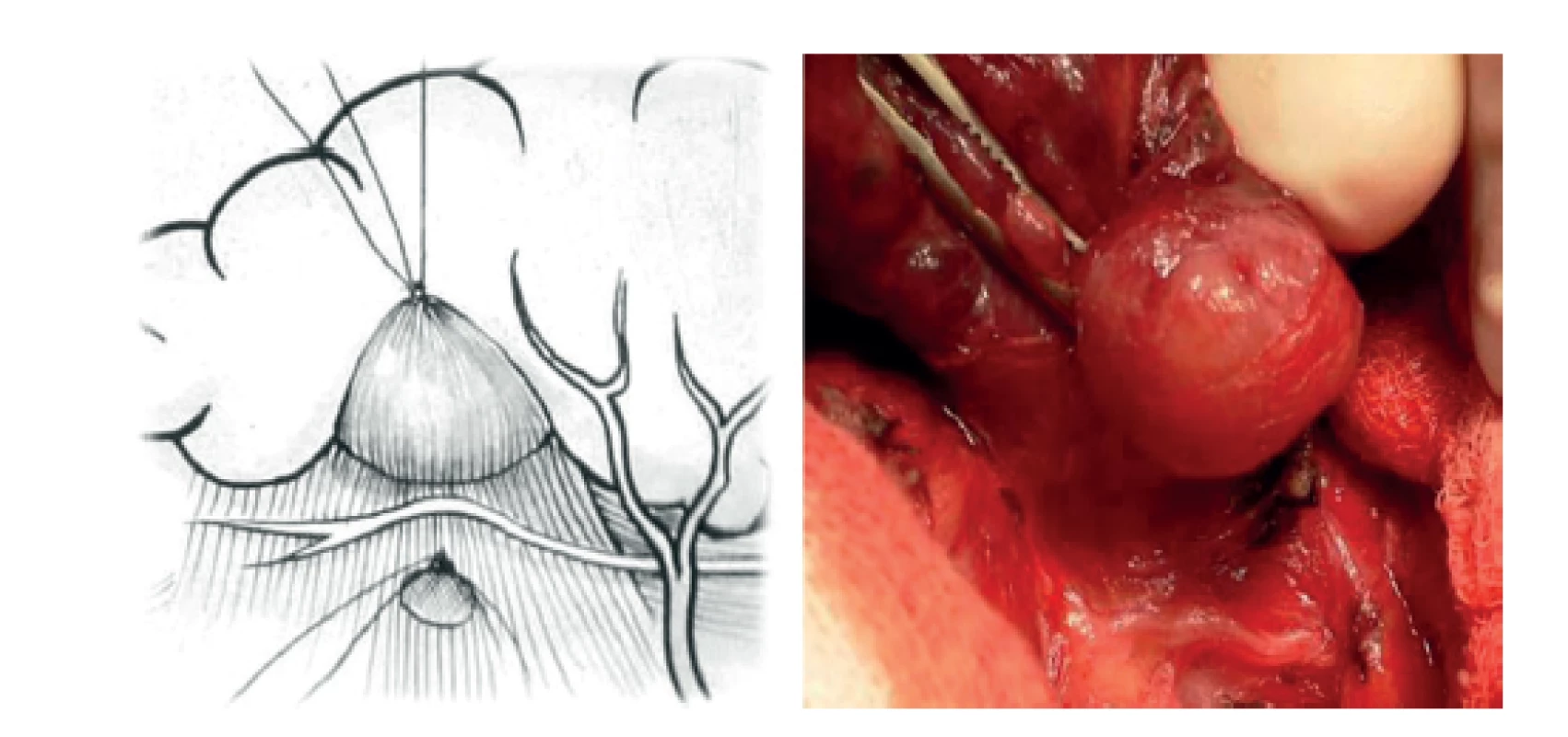 Překlopení stropu „tunelu“ nad probíhajícím NLR<br>
Fig. 5: The overturning of the roof of the tunnel above the
NLR