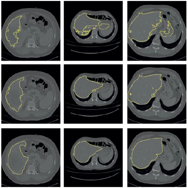 Segmentace jater pomocí konvoluční neuronové sítě s rozšířenou informací o poloze v axiálních řezech z výpočetní
tomografie. Převzato z článku [24]. <br> 
Fig. 3. Liver segmentation using a convolutional neural network with extended information on the position in axial
sections from computed tomography. Source: [24].