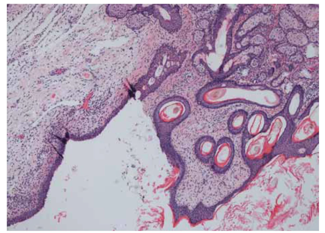 Zralý teratom s gliálnimi buňkami.<br>
Fig. 2. Mature teratoma with glial elements.