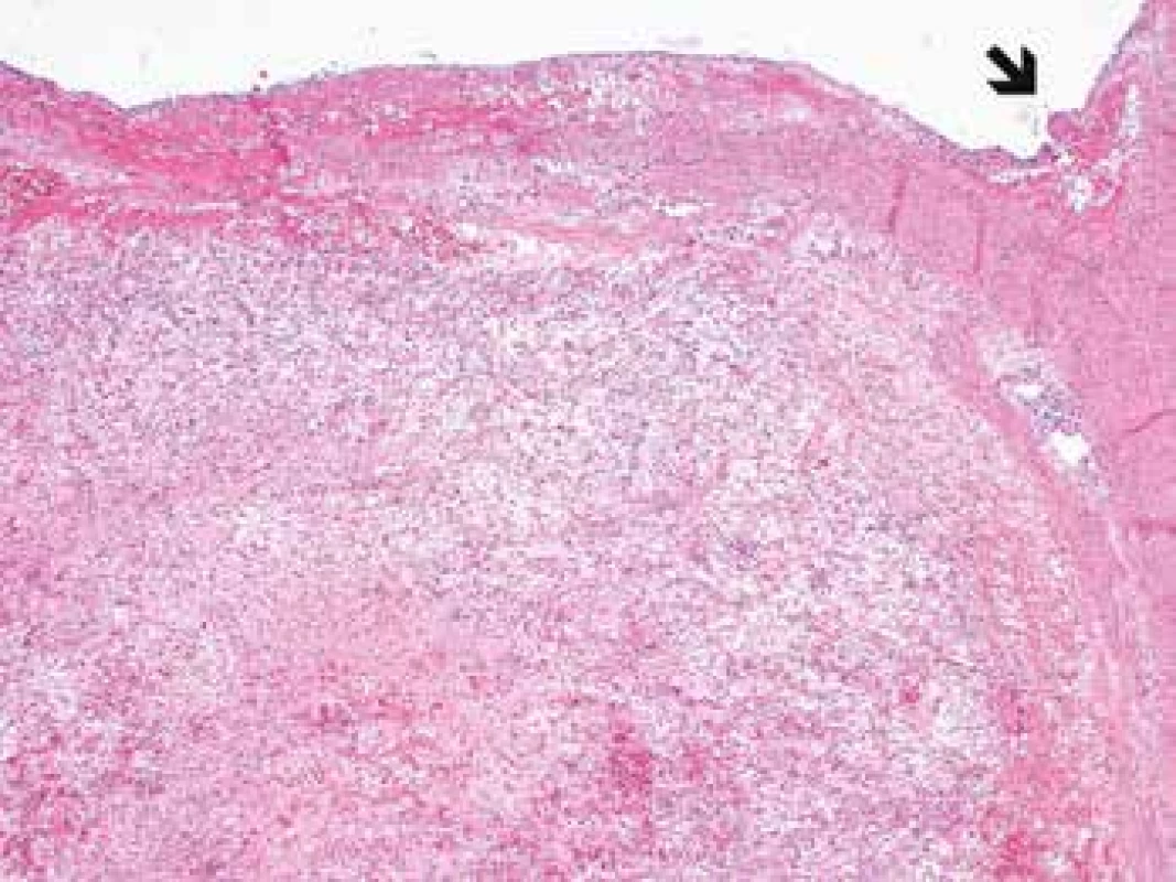 Myofibroplastic proliferation within the aortic wall (arrow) affecting all the histological layers of the aorta (H&E, original magnification 40x).