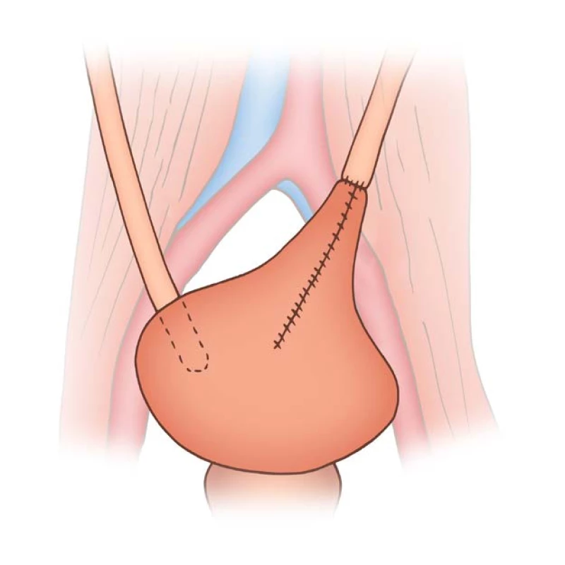 Schéma Boariho plastiky
– tubulizace laloku z měchýře s napojením
na pahýl močovodu (zdroj:
Filip Mareš, licence CC-BY 4.0)<br>
Fig. 3. Boari flap diagram – tubularisation
of a flap of bladder
to extend from the bladder to the
ureteral orifice