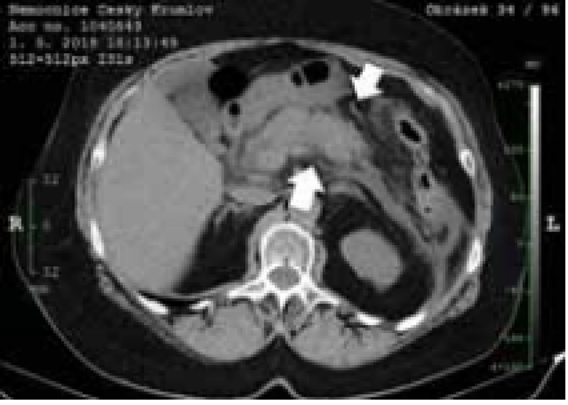 Vstupní nativní CT. Edém pankreatické žlázy s akutní peripankreatickou tekutinovou kolekcí bez známek nekróz (šipka).<br>
Fig. 1. Initial native-phase CT. Edema 
of pancreatic gland with acute peripan creatic fluid collection without 
the signs of necrosis (arrow). 
