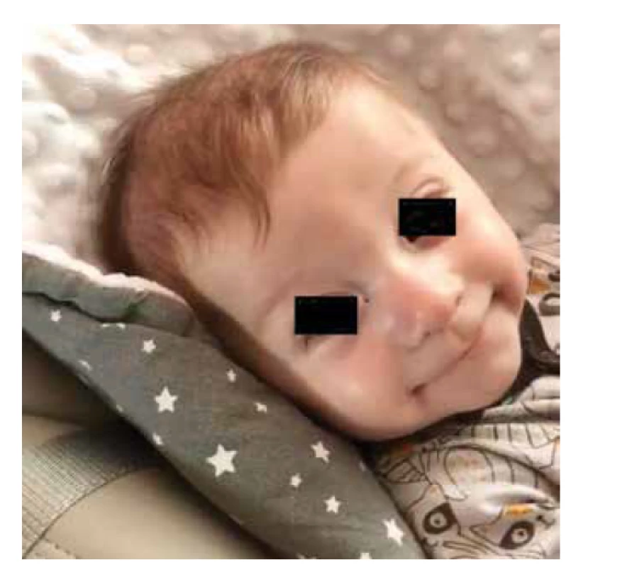 Spokojený prospívající 3měsíční chlapec.<br>
Fig. 2. Photo of the pacient – well growing happy infant,
3 month old.