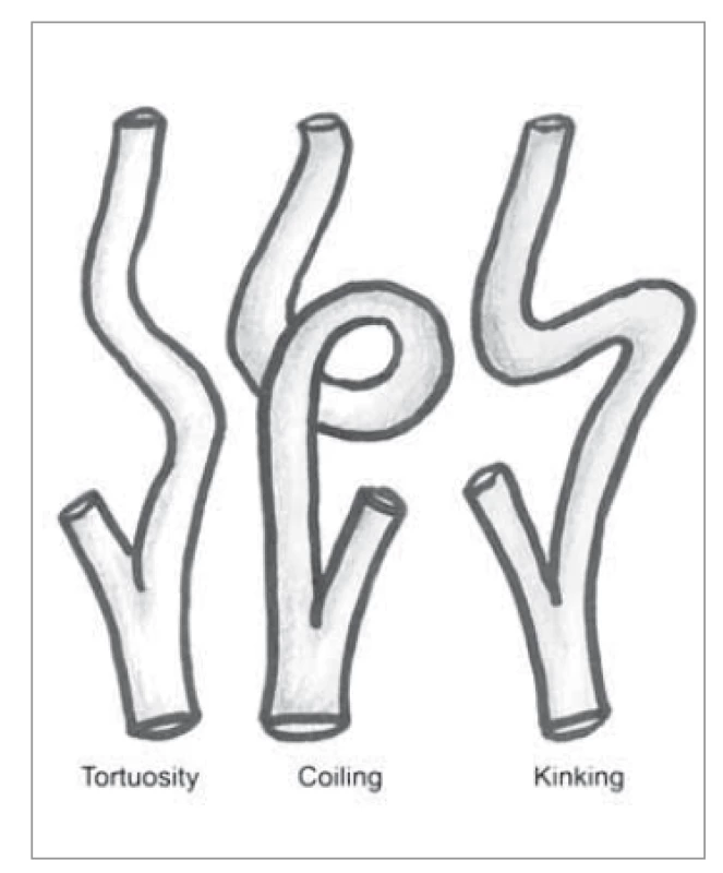 Klasifikace podle Weibela
a Fieldse [17].<br>
Fig. 2. Classification according
to Weibel and Fields [17].