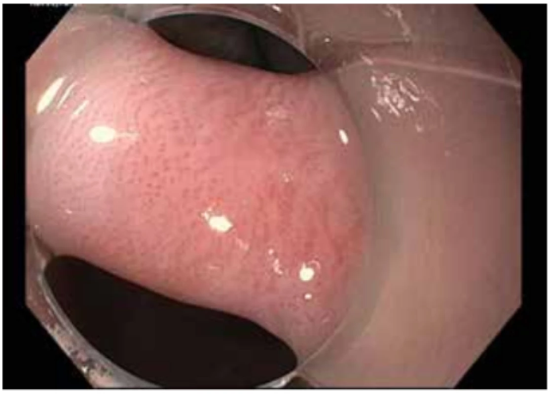 Zenkerův divertikl
Septum rozděluje lumen jícnu, vstup do jícnu je patrný na čísle 12, vstup do divertiklu na čísle 6.
Zdroj: Archiv Odd. gastrointestinální endoskopie ÚVN v Praze<br>
Fig. 1: Zenker‘s diverticulum
The septum divides the lumen of the esophagus; the entry
to the esophagus can be seen in number 12, and the entry to
the diverticulum is shown in number 6.
Source: Archive of the Gastrointestinal Endoscopy Department of the Military University Hospital in Prague