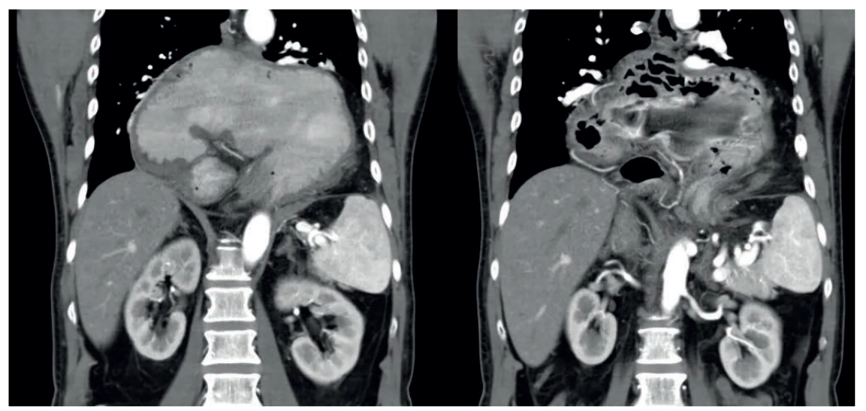 Hiátová hernie s upside-down stomach v CT obraze, na pravém snímku viditelné cévní zásobení žaludku (stejný
pacient)<br>
Fig. 3. Hiatal hernia with upside-down stomach on a CT scan, stomach vessels are visible in the right-hand image (the same
patient)