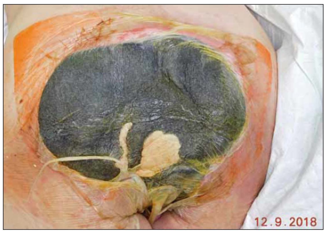 Stav před odstraněním podtlakové terapie.<br>
Fig. 7. Status before removal of negative pressure wound therapy.
