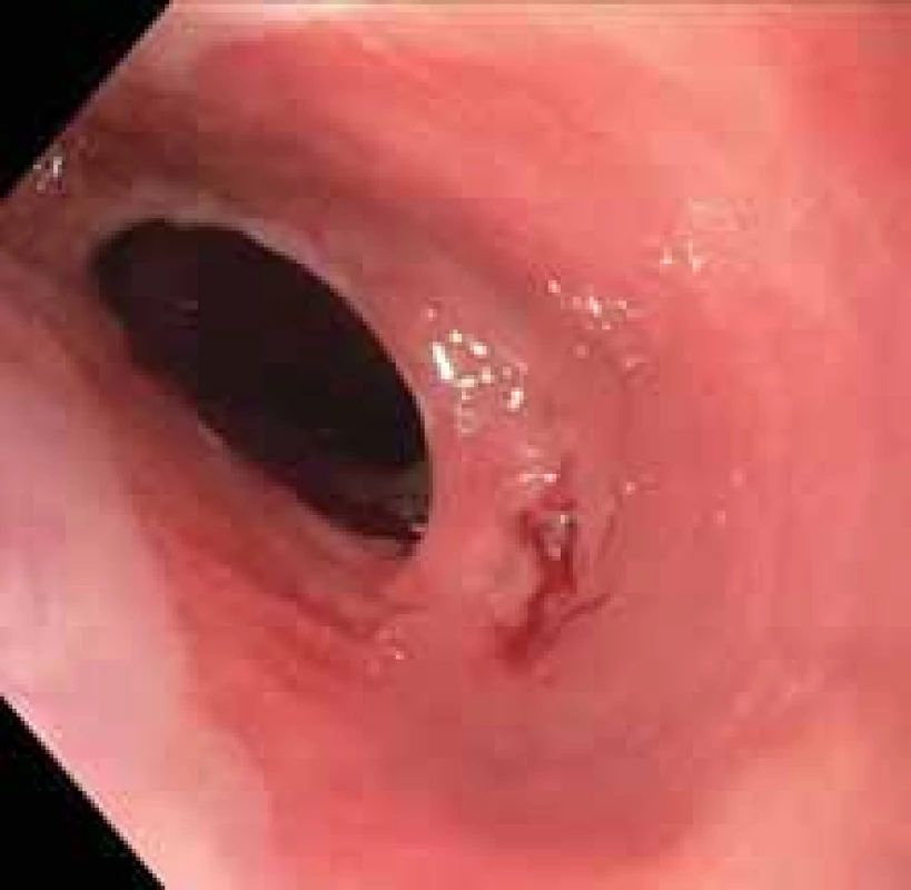 Stenóza v proximálním jícnu
v terénu atypické sliznice.<br>
Fig. 2. Stenosis in the proximal esophagus in the field of atypical mucosa.
