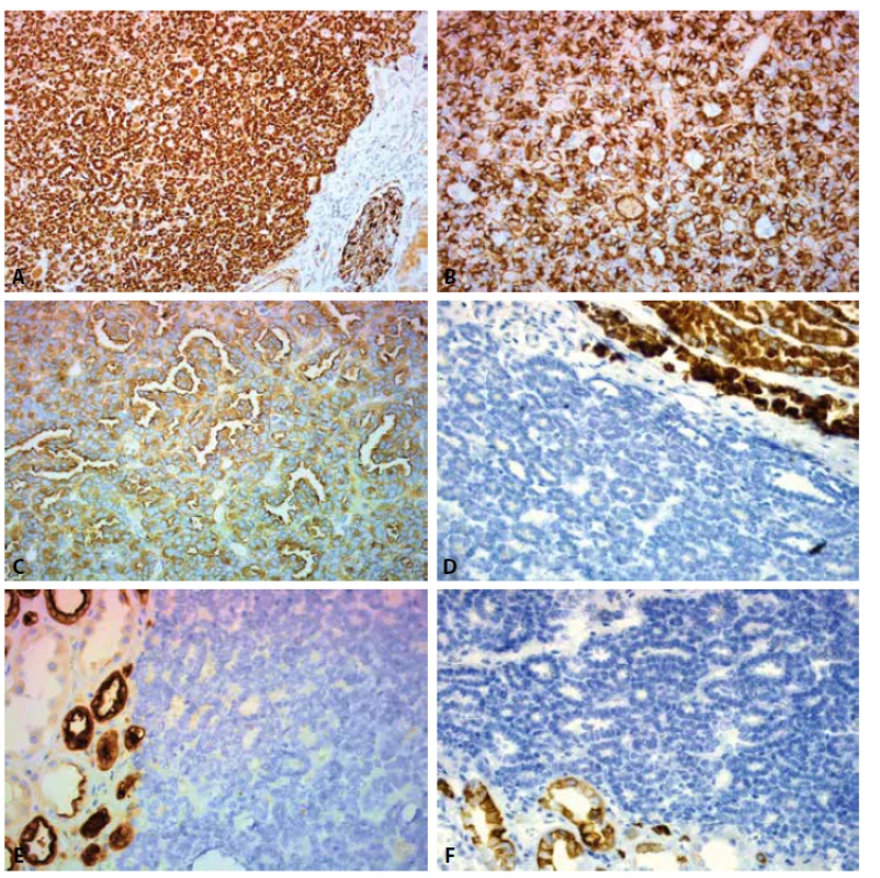 Expression of IHC markers: A. WT1 nuclear expression. Positive control – glomerulus in the adjacent renal parenchyma (200x). B. VIM cytoplasmatic
expression (400x). C. CD57 cytoplasmatic expression (400x). D. Negativity for AMACR in tumor cells. Positive control – kidney proximal
tubules (400x). E. Negativity for EMA in tumor cells. Positive control – kidney distal tubules (400x). F. Negativity for CK7 in tumor cells. Positive
control – kidney collecting ducts (400x).