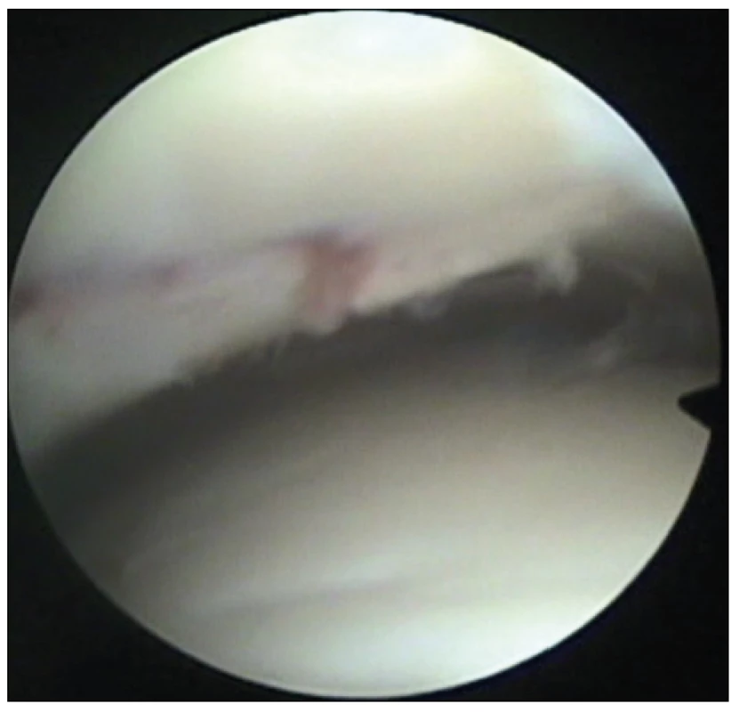  The articular surface was congruent, with a sufficient compression at the fracture line