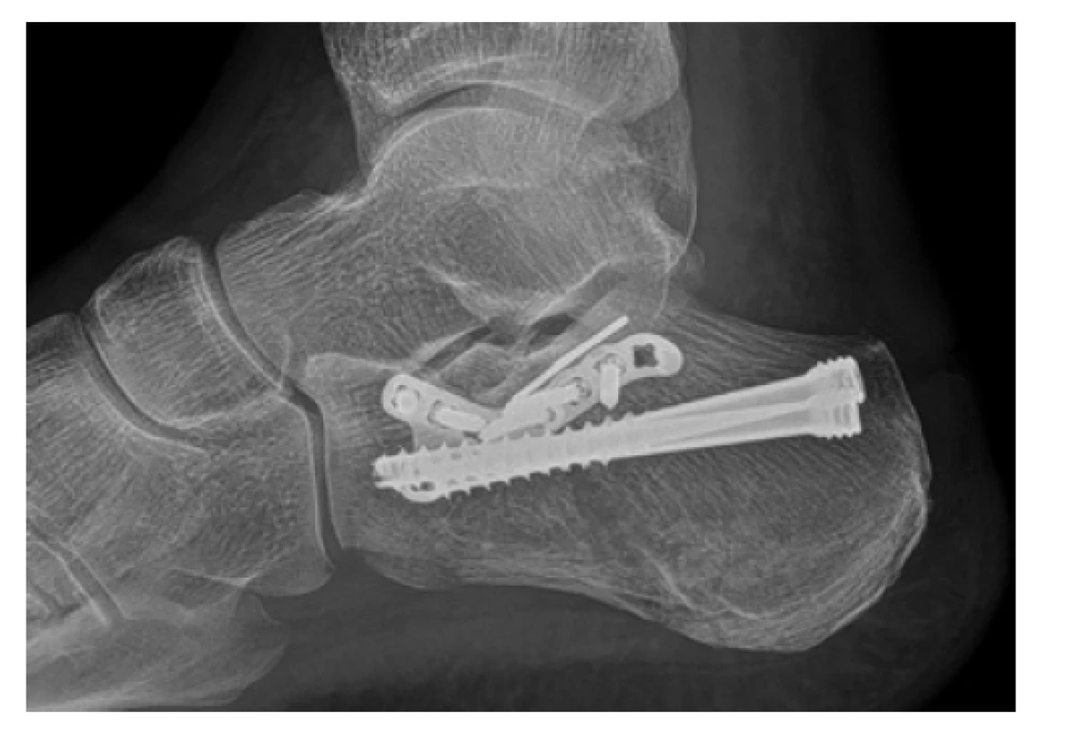 Rentgenový snímek osteosyntézy pomocí anterolaterální
VA-CLP dlahy v kombinaci se zanořitelnými
kompresními šrouby (HCS – vše DePuy Synthes)<br>
Fig. 4: Postoperative X-ray, showing osteosynthesis using
anterolateral VA-CLP plate in combination with countersinkable
compression screws (HCS – all DePuy Synthes
implants)