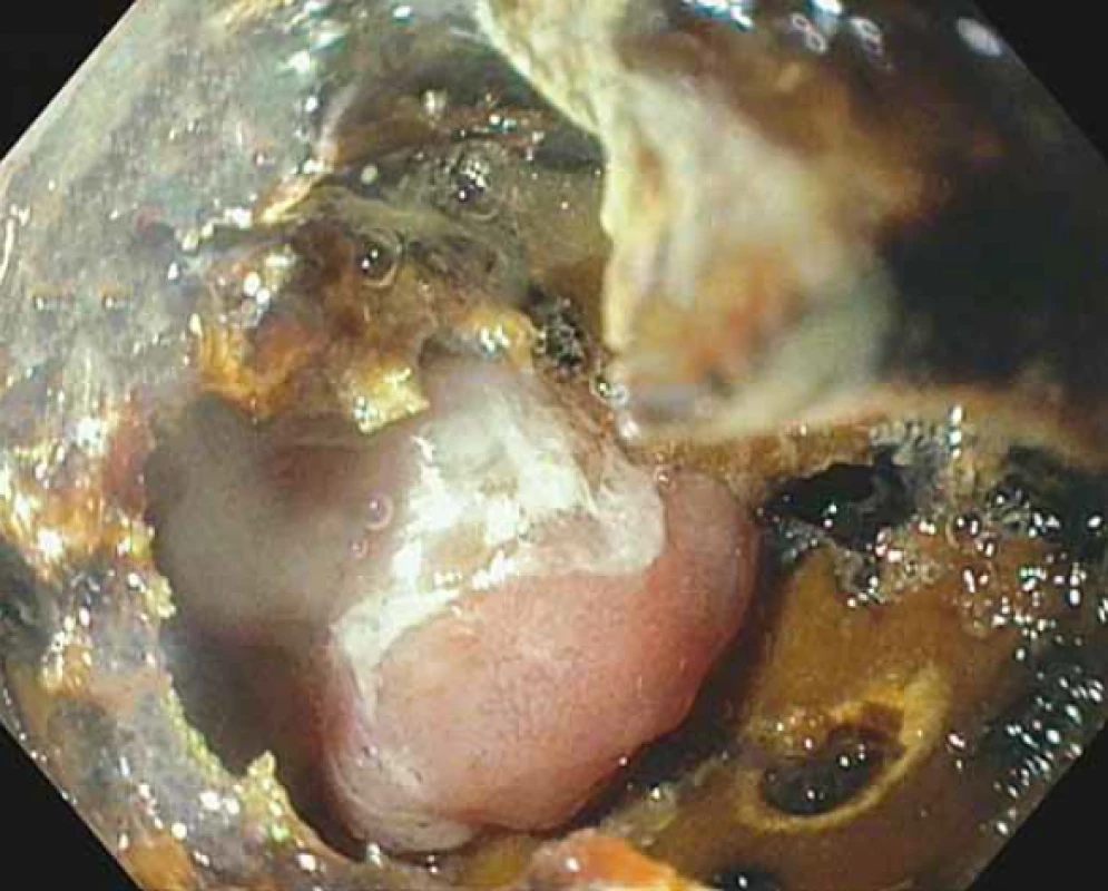 Dezintegrace konkrementu laserovou litotripsií.<br>
Fig. 2. Disintegration of biliary stone by laser lithotripsy.