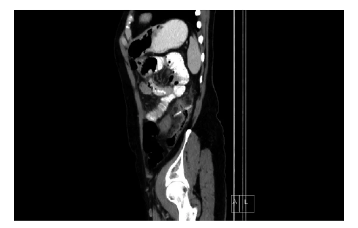 Sagitální CT řez s nálezem cizího tělesa v sestupném
tračníku<br>
Fig. 1: Sagittal CT section with finding of a foreign body in
the descending colon