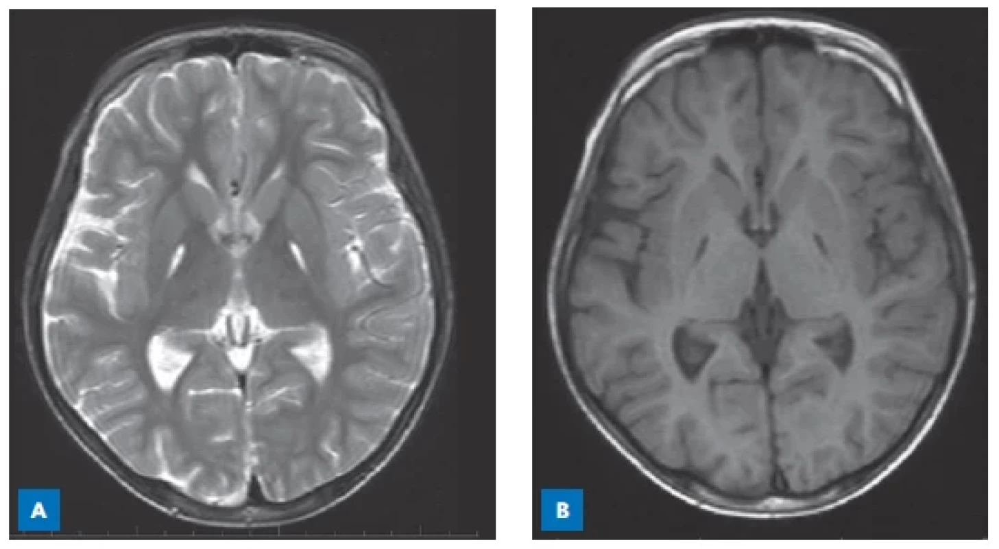 MR CNS 14letého chlapce
s methylmalonovou acidurií. V oblasti
globus pallidus jsou symetrická
pruhovitá ložiska zvýšeného signálu
v T2-vážených obrazech (A) a sníženého
signálu v T1-vážených obrazech (B).
(S laskavostí poskytla Radiodiagnostická
klinika VFN a 1. LF UK, Praha.)
