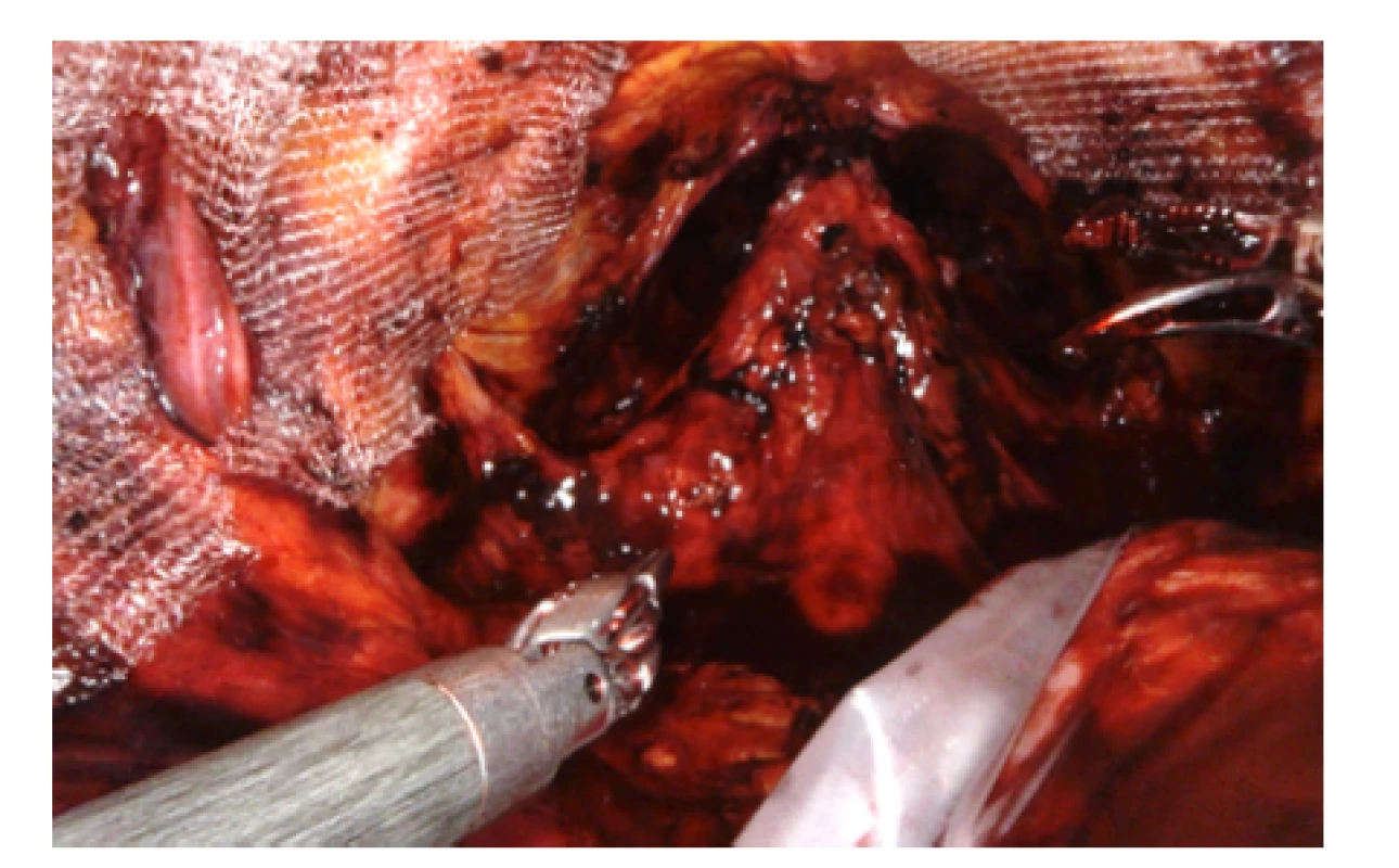 Pohled do pánve na konci operace, po obou
stranách patrná síťka<br>
Fig. 9. View into the pelvis at the end of the operation,
mesh is visible on both sides