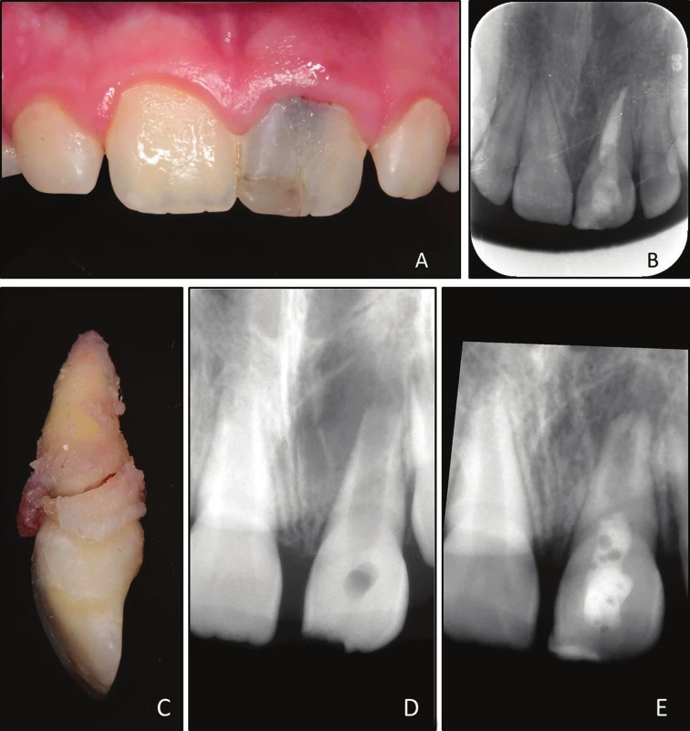 A Clinical photograph taken during follow-up 21 month after root canal treatment; grayish discoloration of tooth 21 is clearly visible; <br>
B intraoral radiograph taken during follow-up 21 month after root canal treatment; <br>
C extracted tooth 21 with oblique fracture, <br>
D aligned preoperative intraoral radiograph of tooth 21;<br>
E aligned postoperative intraoral radiograph of tooth 21 before root canal treatment