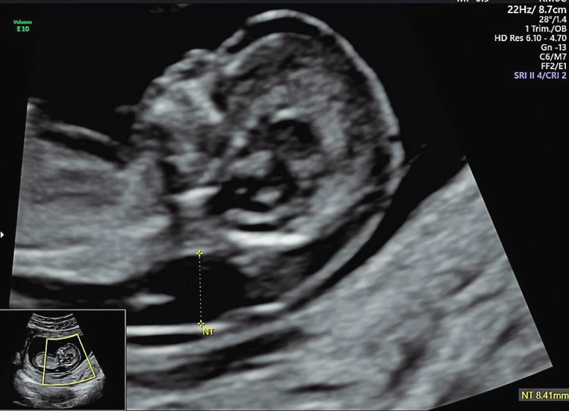 Měření šíjového projasnění (NT) a jeho patologická hodnota.<br>
Fig. 1. Measurement of nuchal translucency (NT) and its pathological value.