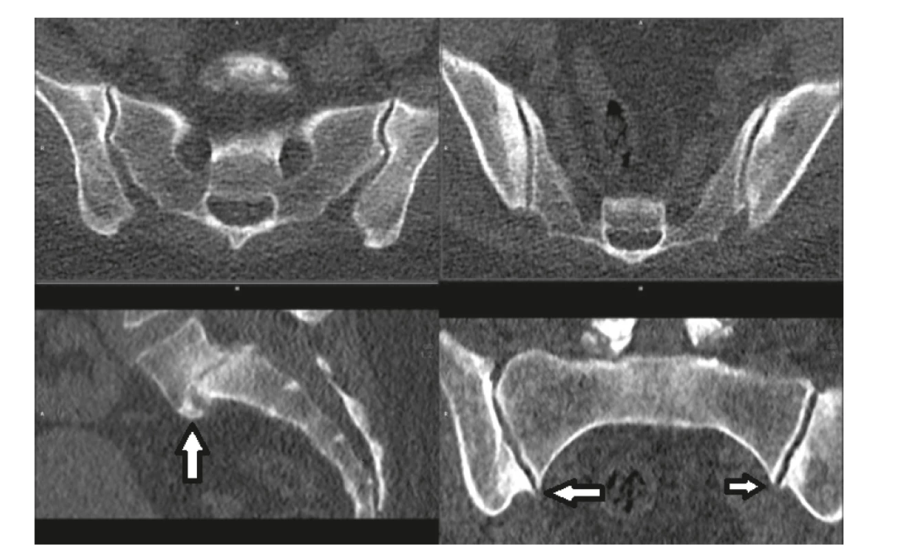 Sn LDCT. Na SI kloubech nejsou známky zánětlivých změn na skeletu. Pacient trpí artrózou. Jako vedlejší nález byla odhalena
spondylolistéza L5/S1 (šipka) s oboustrannou spondylolýzou oblouku a nasedajícími pokročilými spondylo-degenerativními změnami,
které mohou být příčinou bolesti dolních zad.