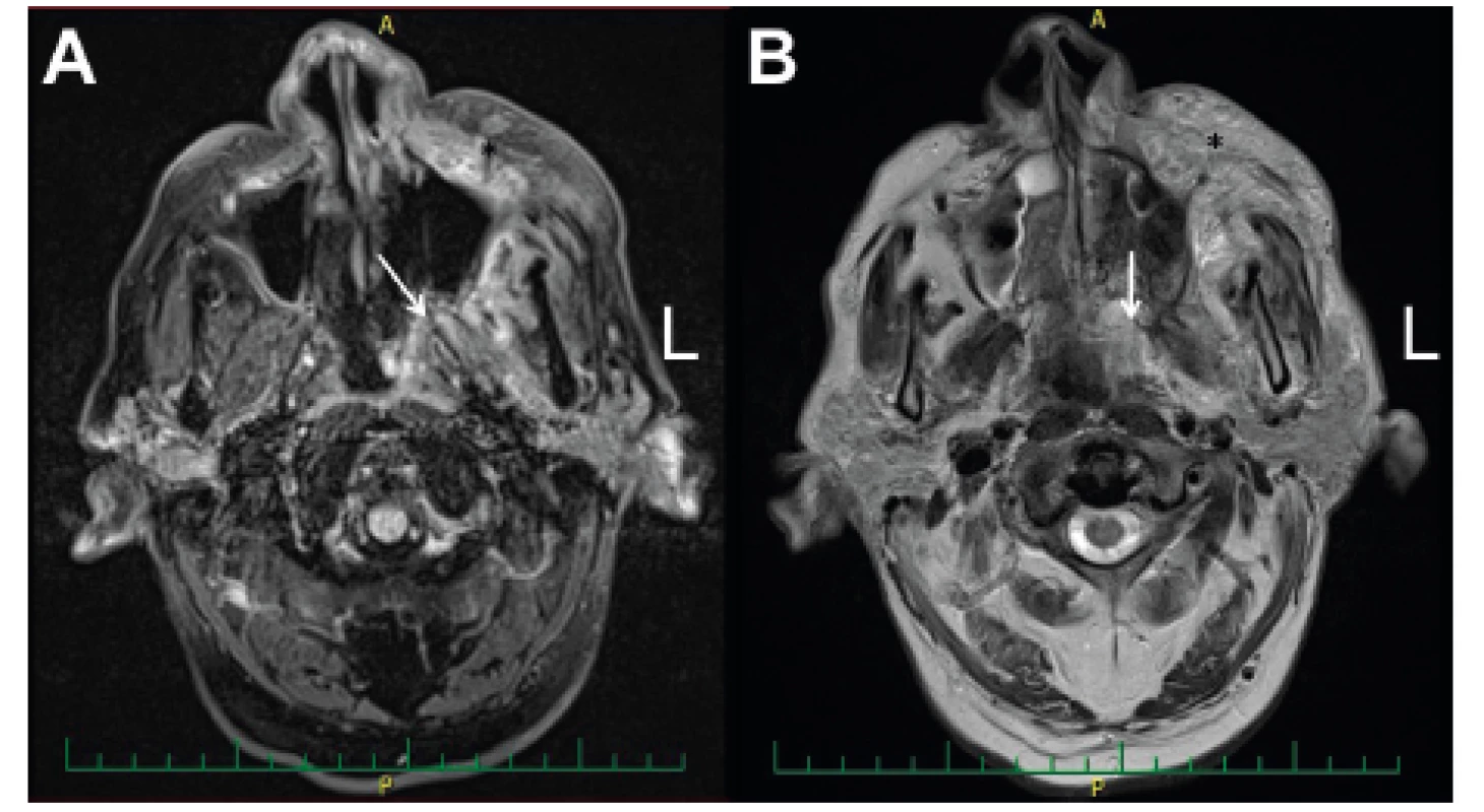 MRI vedlejších nosních dutin - předoperačně před radikálním
resekčním chirurgickým výkonem.<br>
A-T1 vážení (zánětlivá infiltrace fossa pterygopalatina (viz šipka)
a tkání levé tváře (viz *); B-T2 vážení (zánětlivá infiltrace tkání
fossa pterygopalatina (viz šipka) a tkání levé tváře (viz *)