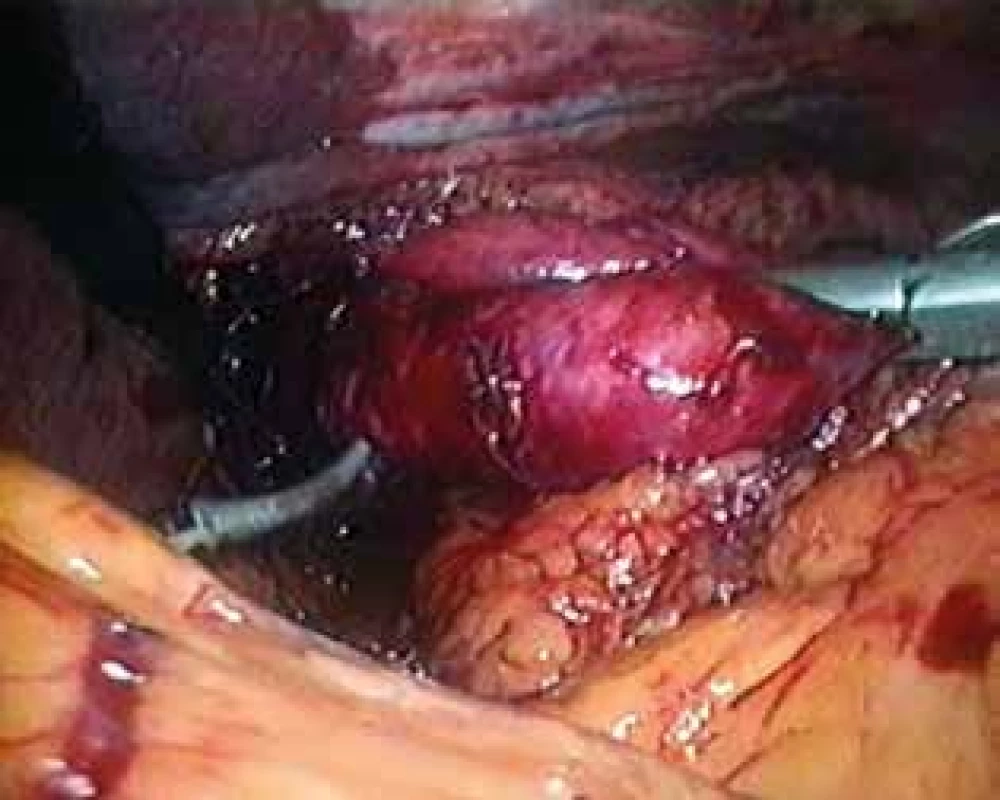 Epifrenický divertikl retrahován grasperem z mediastina při transhiatální laparoskopické preparaci <br>Fig. 7: Epiphrenic diverticulum retracted from the mediastinum using a grasper in transhiatal laparoscopic preparation