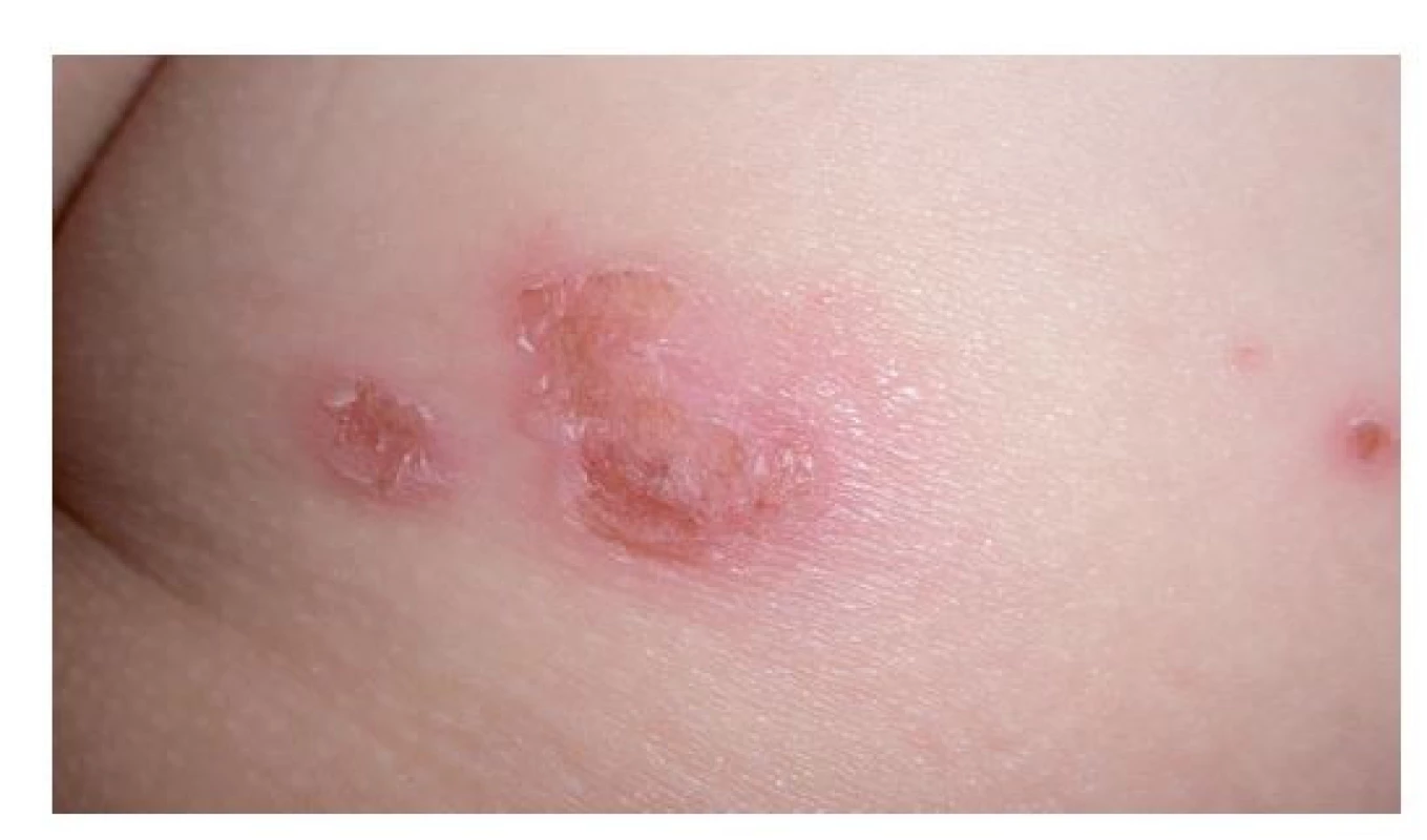Počínající impetigo na zadečku pětiletého děvčátka
