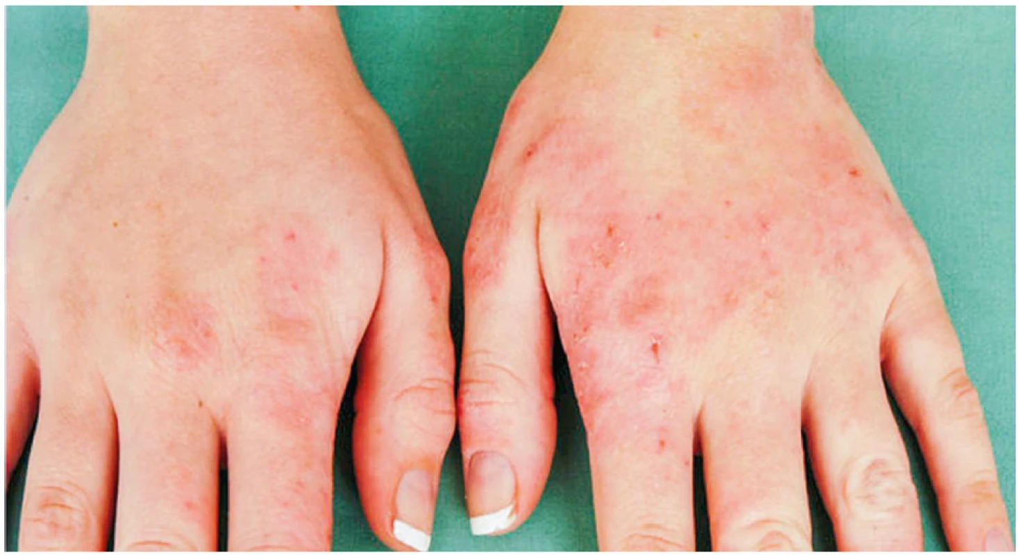 Eczema contactum prof. – parafenylendiamin+++, 4-aminofenol+++, disperzní oranž+++, amonium persulfát+++, thiuram-mix+++,
nikl+++, kobalt++, pladium++ – kadeřnice