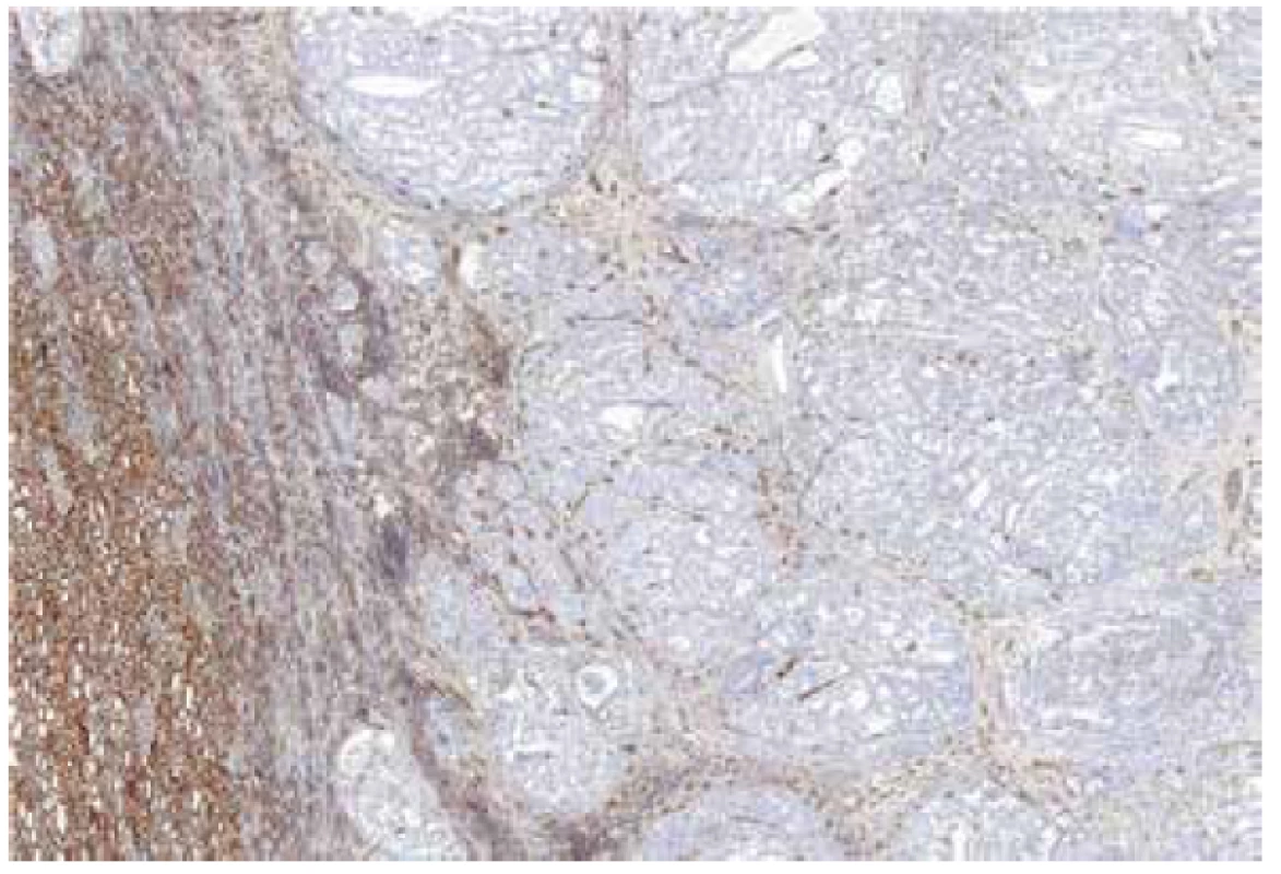 Renal cell carcinoma mimicking FHRCC (no mutation/LOH of FH gene
detected) with negative immunohistochemical staining for FH. 40x