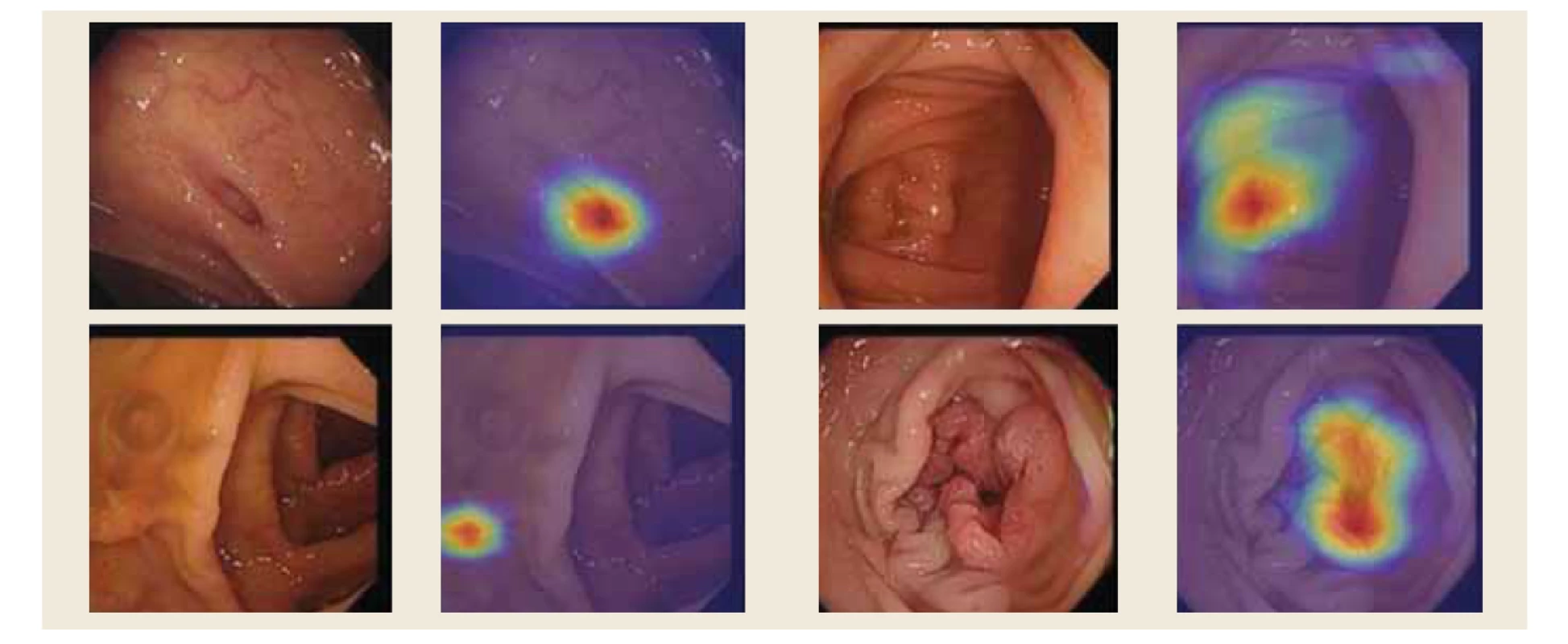 Prostorová lokalizace lézí tlustého střeva pomocí teplotních map: A) divertikl, B) cékum, C) polyp a D) rakovina.<br>
Fig. 1. Spatial localization of colon lesions using temperature maps: A) diverticulum, B) cecum, C) polyp and D) cancer.