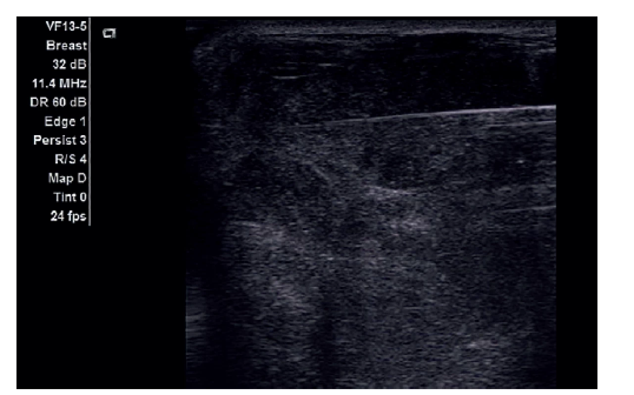 Bioptická verifikace tumorozní infiltrace prsu pod
UZ kontrolou.<br>
Fig. 3: Ultrasound guided biopsy of the tumor infiltration
of the breast.
