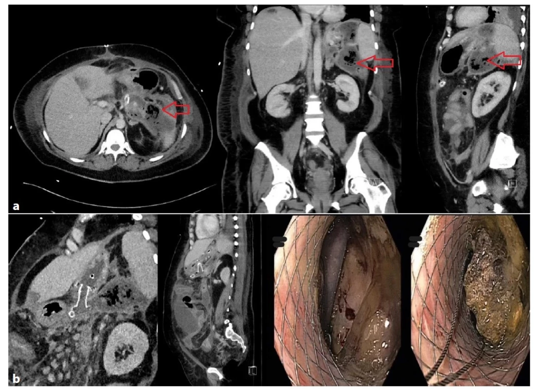 a−2b: Těžký průběh alkoholické pankreatitidy s MOF u 41leté pacientky<br>
Chirurgická revize dutiny břišní a laparostoma pro kompartment syndrom. Ohraničená kolekce tekutiny v epigastriu s bublinami
plynu velikosti 65×140×185 mm (Obr. 2a), perkutánní drén nefunkční. Kolekce byla drenována transgastricky kovovým lumen
apozičním stentem (Obr. 2b). Po opakované nekrektomii regrese ložiska. Délka hospitalizace 269 dnů, z toho ventilována 92 dnů.<br>
Fig. 2a−2b: Severe course of alcoholic pancreatitis with MOF in a 41-year-old woman<br>
Surgical revision with a laparostoma due to compartment syndrome. Circumscribed fluid collection in the epigastrium sized
65×140×185 mm with gas bubbles (Fig. 2a); the percutaneous drain was dysfunctional. The collection was drained transgastrically
by the lumen-apposing metal stent (Fig. 2b). Regression of deposits in the epigastrium after repeated necrectomy. Hospital stay
was 269 days; the patient was ventilated for 92 days.