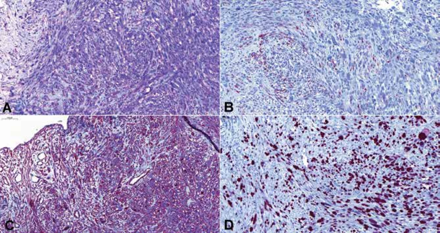  Imunohistochemicky byla prokázána exprese markerů hladkosvalové diferenciace: difuzní slabší exprese hladkosvalového aktinu (A), ložisková silná exprese desminu (B) a difuzní silná exprese h-caldesmonu (C) <br>Proliferační aktivita (imunohistochemický průkaz proliferačního antigenu Mib-1) byla vysoká (D) (zvětšení A – 150krát, B – 200krát, C – 150krát, D – 200krát).