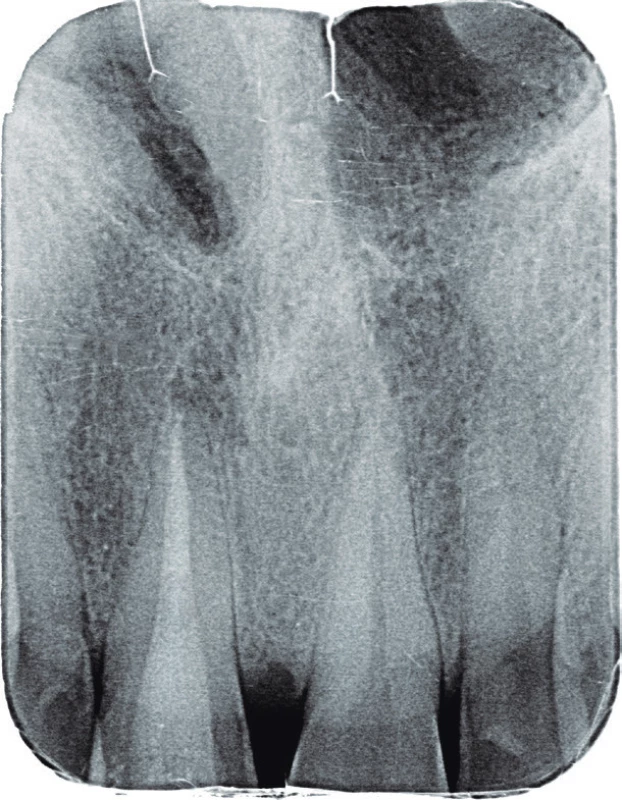Intraorální
rentgenový snímek
zubu 11 v apikálním
zastavení po ukončeném
reendodontickém
vyšetření