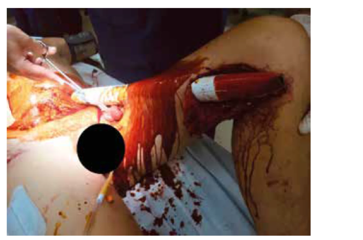 Vstup trubky – levé steno<br>
Fig. 8: Entry of the tube – left thigh