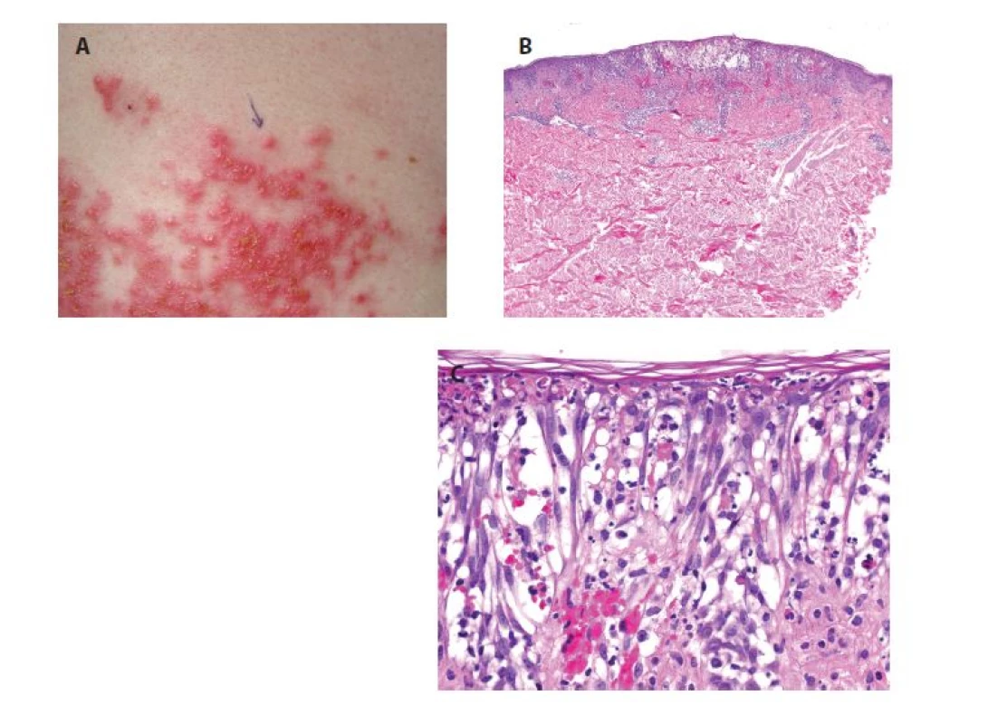 Prurigo pigmentosa<br>
a) bioptovaná papulovezikula<br>
b) perivaskulární spongiotická a vezikulózní
dermatitida s erytrocytárními extravazáty (HE
40x)<br>
c) epidermis je kryta proužkem ortokeratózy,
vykazuje výraznou spongiózu až spongiotický
intraepidermální puchýř s přítomností shluků
neutrofilů, s eytrocyty, ojedinělými eozinofily
a nekrotickými keratinocyty (HE 400x).