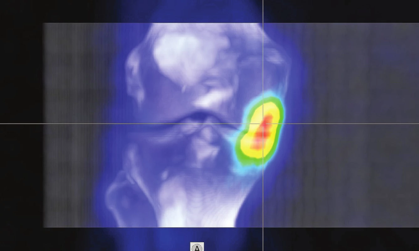 3D fúze SPECT/CT obrazu u pacienta s osteochondrálním
defektem mediálního kondylu femuru v pozdějším stádiu a s přestavbovou
aktivitou i protilehlého konce tibie.