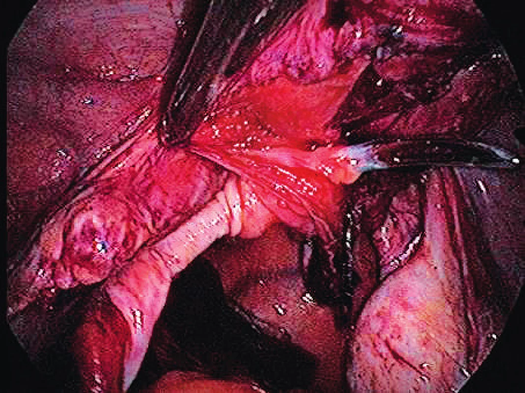 Second-sided insertion of Serapro RTD
