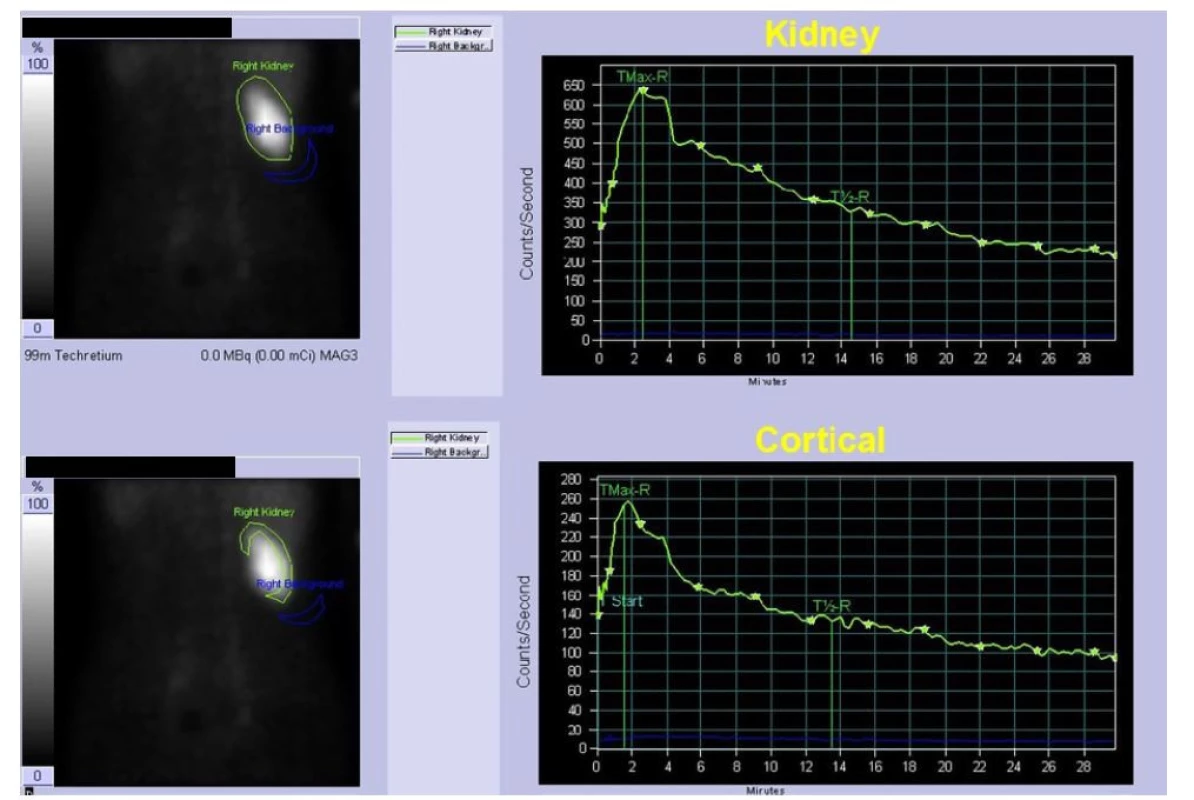 Dynamická scintigrafie ledvin – funkce solitární ledviny<br>
Fig. 3. Dynamic scintigraphy of kidney – function of solitary kidney