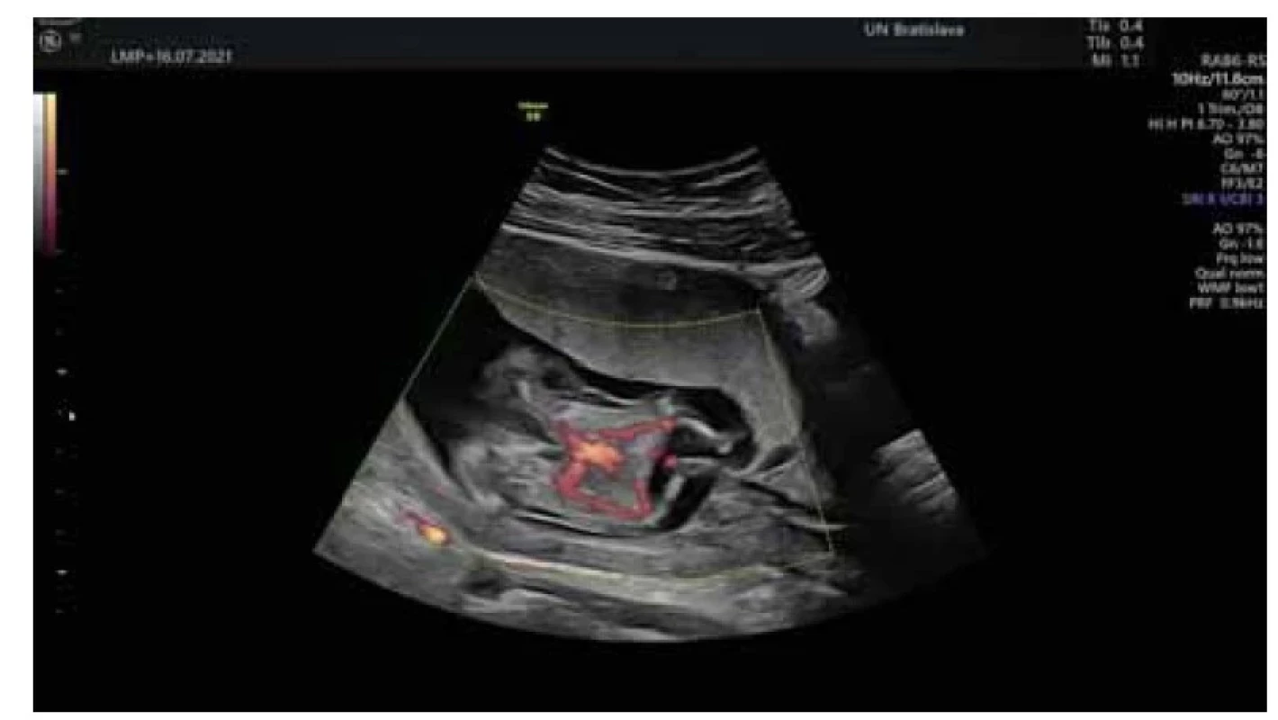 Zobrazené dva aortálne oblúky odstupujúce zo spoločného srdca
do oboch plodov (archív II. GPK LF UK a UN Bratislava).<br>
Fig. 1. Two aortic arches emerging from the common heart to both fetuses are
shown (archive II. GPK LF UK and UN Bratislava).