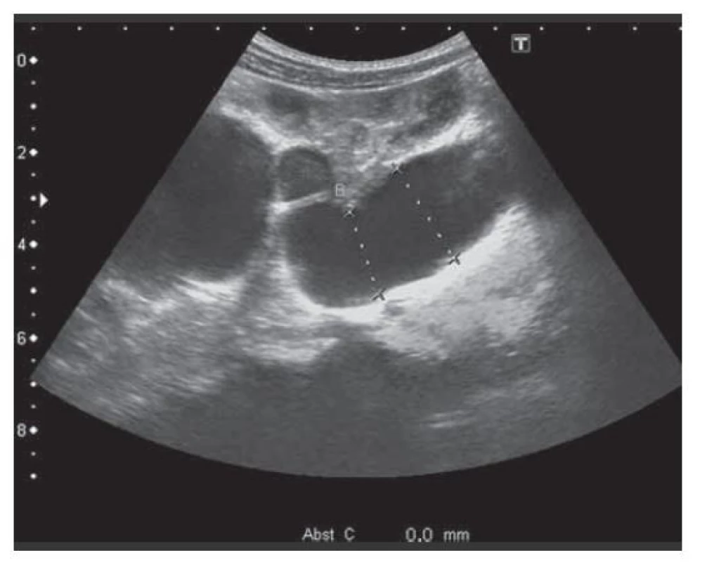 Megaureter – archiv FN Olomouc, urologická
klinika, ilustrační foto.<br>
Fig. 4. Megaureter – archive Faculty Hospital Olomouc,
Urological Clinic, illustrative photograph.
