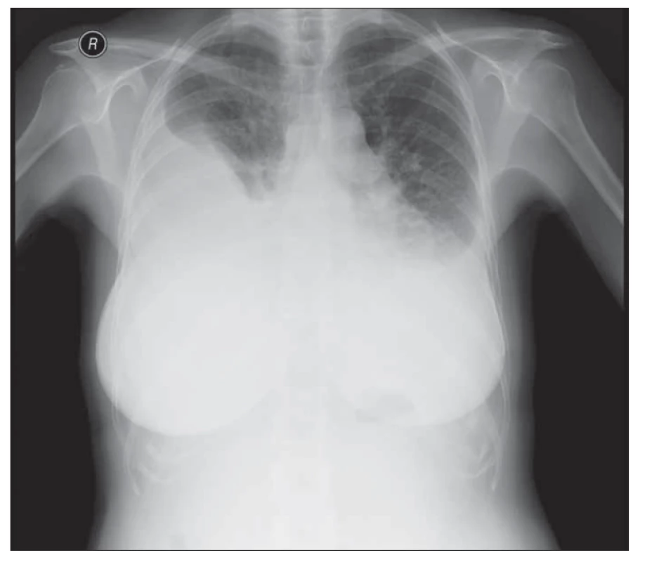 Rentgenový snímek hrudníku pacientky ze 7. 7. 2020 (předozadní
projekce) – Fluidothorax vpravo je v minimální progresi, dosahuje do úrovně
ventrálního průběhu 2.–3. žebra. Vlevo je fl uidothoax stacionární, dosahuje
do úrovně ventrálního průběhu 3. žebra. Srdeční stín je nehodnotitelný.
Horní mediastinum není rozšířeno. V malém oběhu je patrná hyperemie.