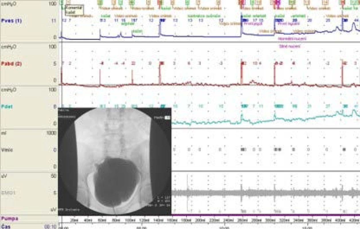 Kontrolní videourodynamické vyšetření 2010<br>
Fig. 6. Videourodynamic control 2010