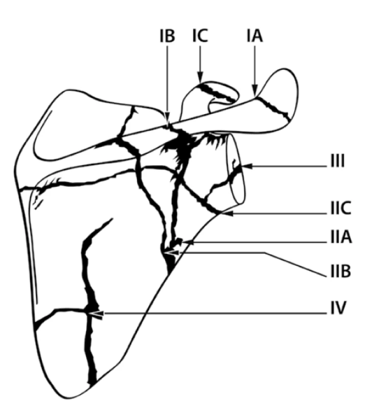 Classification of Ada and Miller. II – fractures of
scapular neck (Figure adapted from Ada and Miller, [1]).