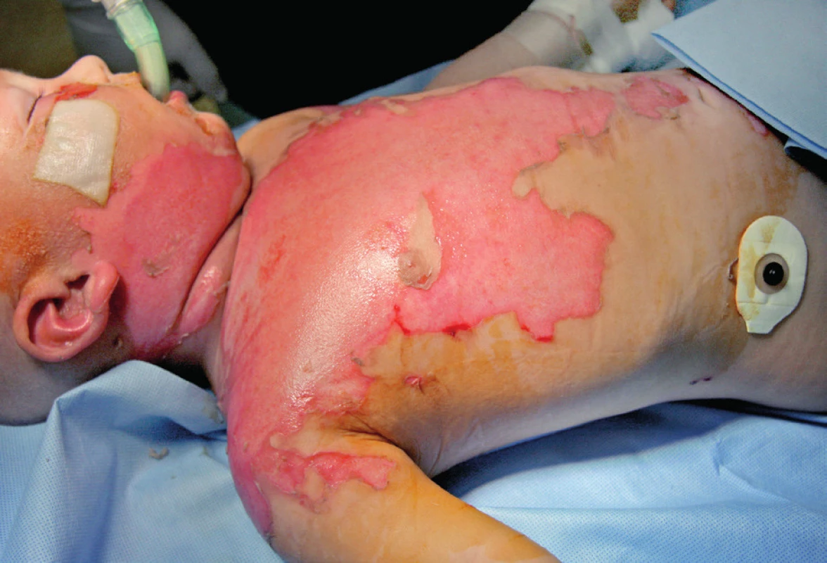 Post-burn day 3: Deepening of the wound to mixed
second-degree burns